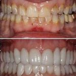 Full Mouth Rehabilation