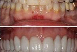 Full Mouth Rehabilation