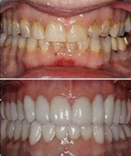 Full Mouth Rehabilation