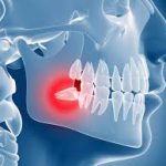 Surgical tooth extraction
