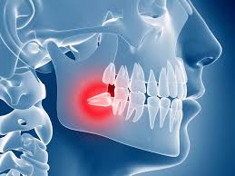 Surgical tooth extraction